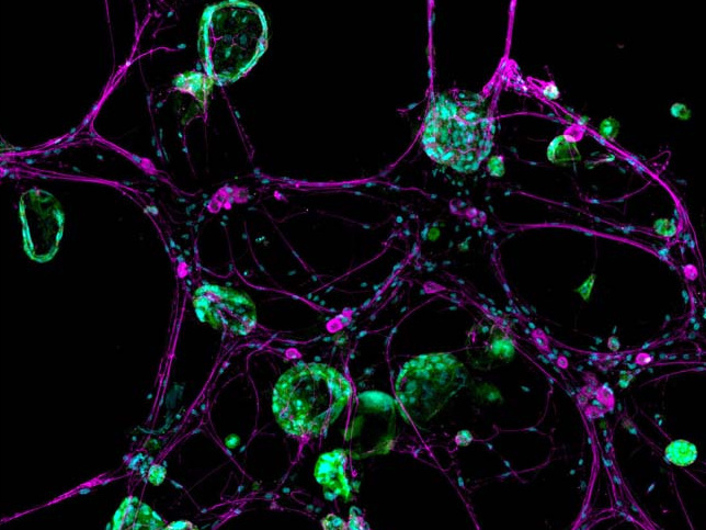 Cancer cells interact with nerve cells in a pancreatic organoid. <a href="https://ki-images.mit.edu/2023/su-3"_blank><strong>2023 KI Image Award Winner</strong></a>